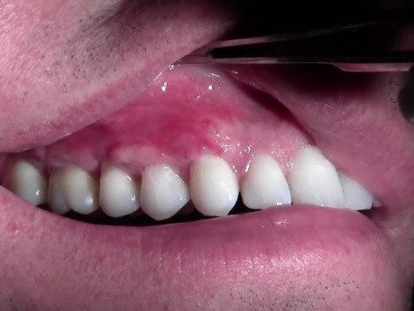 Gingival Grafting #3-6 Sites - Post-Op Healing - 2 Weeks Out