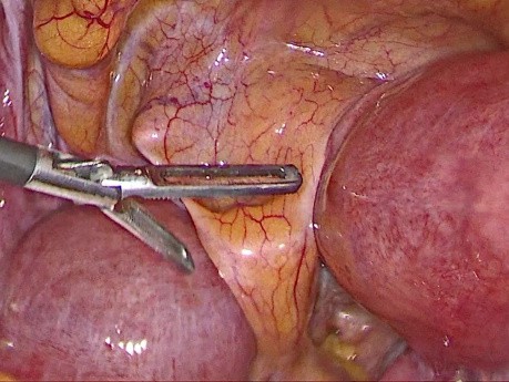 TLH for Bicornuate Uterus