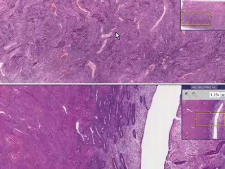 Senile atrophy - Histopathology - Endometrium