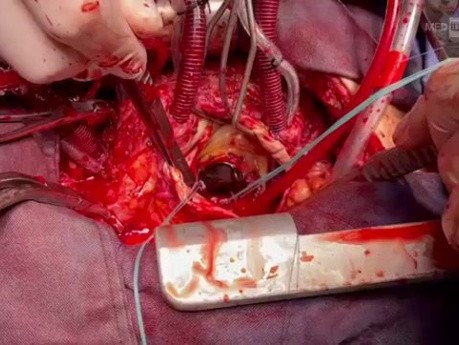 Beating Heart Paravalvular Leakage Surgery 