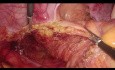 Laparoscopic Intersphincteric Resection for Intra-Anal Cancer - Full Length Procedure