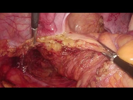 Laparoscopic Intersphincteric Resection for Intra-Anal Cancer - Full Length Procedure