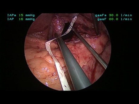 Geometry Fundoplication App Tutorial, Chapter 05 - Closure of the Diaphragmatic Hiatus