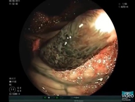 Giant Colonic Angiodysplasia