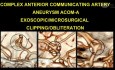 Anterior Communicating Artery Aneurysm-acom-a-exoscopic Microsurgical Clipping/Obliteration