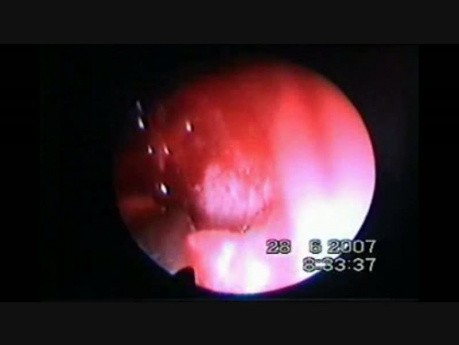 Pediatric Endoscopic DCR in Postsaccal Obstruction - Part 1