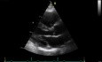 Real-Time Three Dimensional Echocardiography - Parasternal Long Axis View on Mitral Valve, Video nr 1