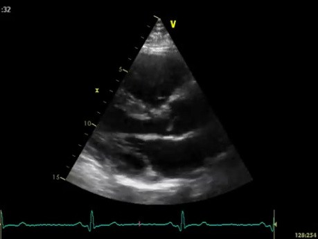 Real-Time Three Dimensional Echocardiography - Parasternal Long Axis View on Mitral Valve, Video nr 1