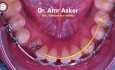 Step by Step Orthodontic Archwire Insertion for Rotated Canine Traction