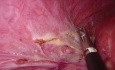 Laparoscopic Hydatid Cyst Excision Located in Segment 7