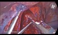 Saving the Hepatic Branch of the Anterior Vagus Nerve in Heller Myotomy and Dor Fundoplication for Achalasia