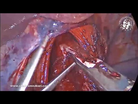 Saving the Hepatic Branch of the Anterior Vagus Nerve in Heller Myotomy and Dor Fundoplication for Achalasia