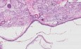 Dermoid cyst - Histopathology of ovary