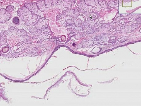 Dermoid cyst - Histopathology of ovary