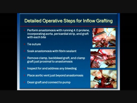 Heartmate II LVAD Outflow Grafting Technique