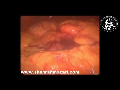 Laparoscopic View: Acute Edematous Pancreatitis