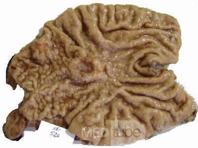 Adenocarcinoma of the Antrum and incisura angularis (4 of 12)