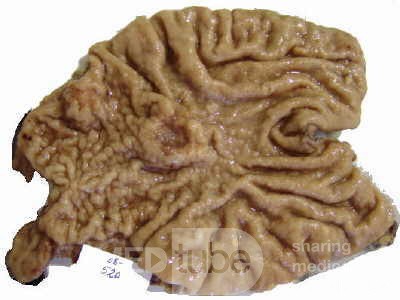 Adenocarcinoma of the Antrum and incisura angularis (4 of 12)