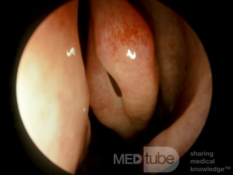 Concha Bullosa Left Middle Turbinate with Direct Air Hole