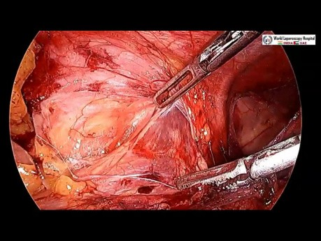 TAPP Hernia Repair by Ipsilateral Port