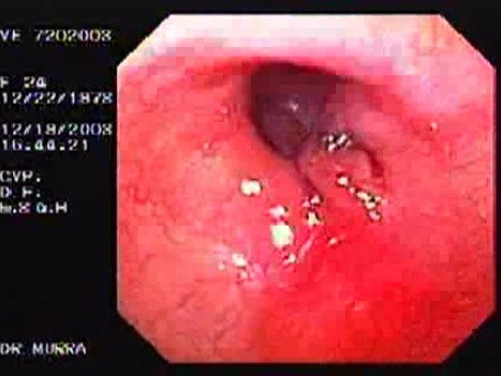 Flexible Endoscopic Suturing - End of The Gastroplication