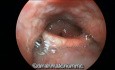The Typical Laryngeal Endoscopy Appearance in Reflux Laryngitis