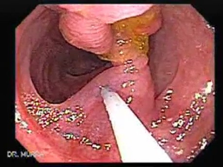 Colonoscopic Polypectomy (5 of 29)