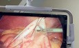 Laproscopic Assisted ERCP in Gastric Bypass