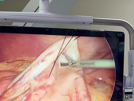 Laproscopic Assisted ERCP in Gastric Bypass