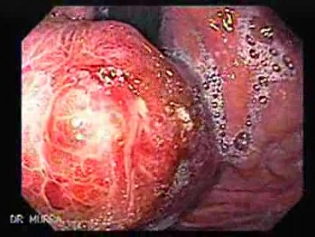 Gastric Varices - Endoscopic Ablation With Cyanoacrylate Glue (13 of 18)