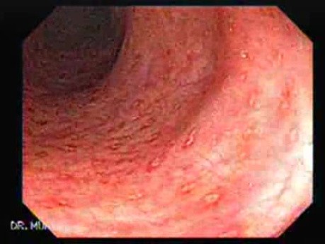 Crohn´s Colitis (3 of 3)