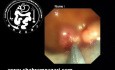Clip Closure Piecemeal EMR Colon Polyp Resection