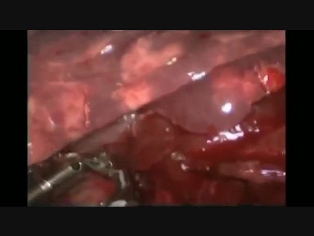 Awake Uniportal VATS Middle Lobectomy (Congenital Malformation)