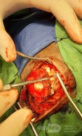 Epicranial Tumor Injury