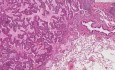 Bronchiolo-alveolar carcinoma - Histopathology - Lung