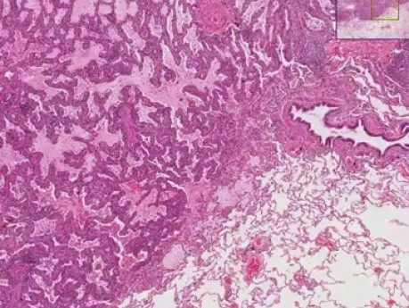 Bronchiolo-alveolar carcinoma - Histopathology - Lung