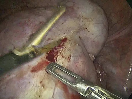 Bilateral Big Size Dermoid Cyst Excision with Both Ovaries Preservation Done with Laparoscopy 