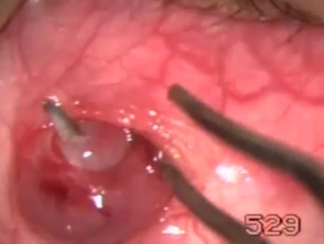 Inferior Oblique Myomectomy - Fugo Blade