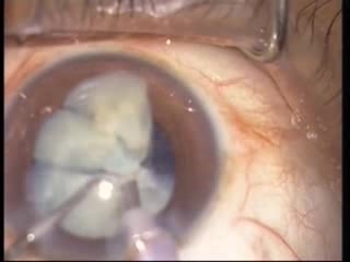 Phacoemulsification - Horizontal Chopping In Hypermature Shrunken Case 