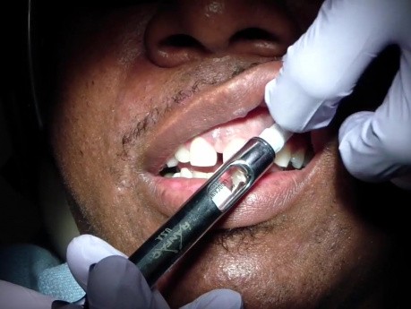 Almost Pain Free Local Anesthesia Anterior Maxilla: Step 1