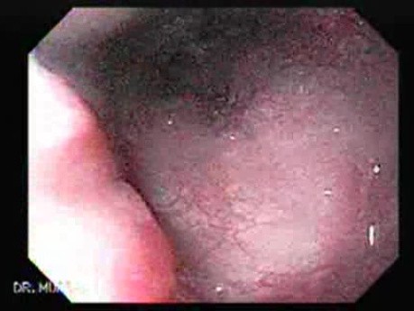 Gastro-Esophageal Varices - Insertion of the Endoscope