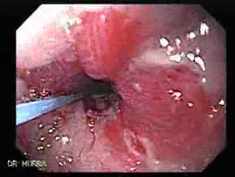 Endoscopic Baloon Dilation Of The Esophageal Stricture - Position Of The Deflated Baloon