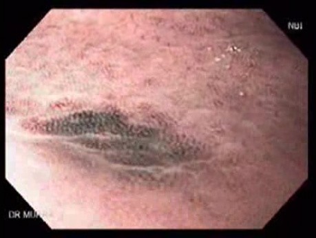 Gastric Erosion (1 of 3)
