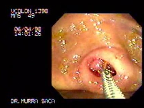 Stalk Polyp Inside of the Appendiceal Orifice (1 of 2)