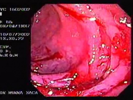 Diverticulum - Perforation