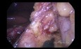 Laparoscopic Double-Tract Proximal Gastrectomy