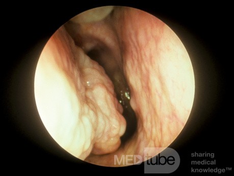 Enlarged Posterior end of a Right Inferior Turbinate