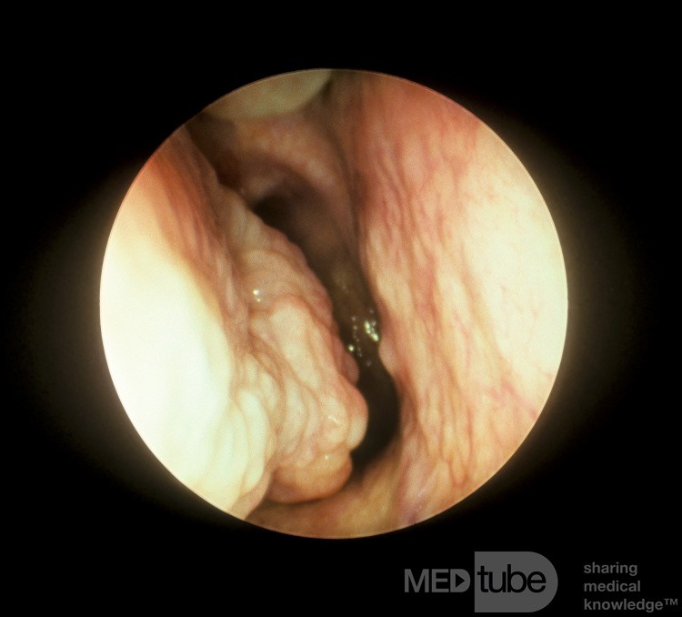 Enlarged Posterior end of a Right Inferior Turbinate