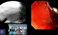Navigating the Pyloric Border, ERCP for Choledocho-duodenal Anastomotic Stricture