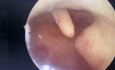Endometrial Polyp by Hysteroscopy